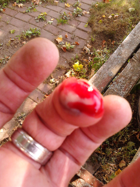 2016.11.August: 16.20 Got a blister AND the blister burst at the same time.