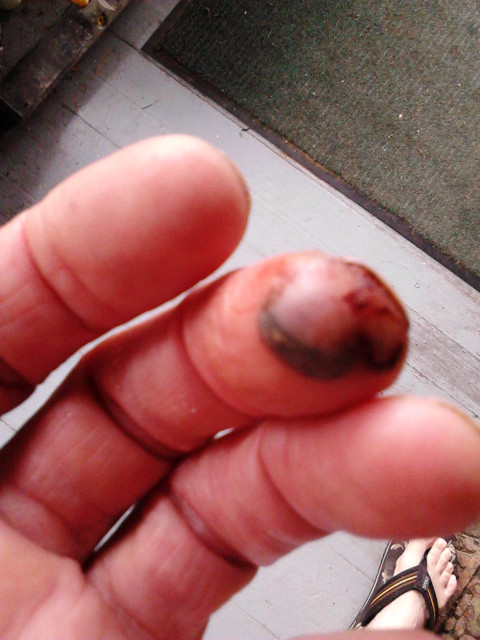 2016.12.August: 09.56 The "morning after". Looks like Hell but big blister, no pain.