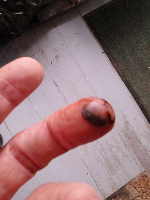 2016.12.August: 09.57 The puddled blood solidified & is keeping the blister sealed.